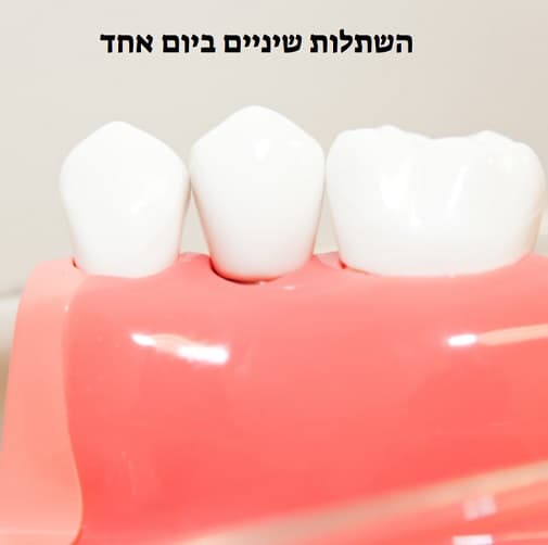 השתלות שיניים ביום אחד מספר עובדות שכדי לדעת 